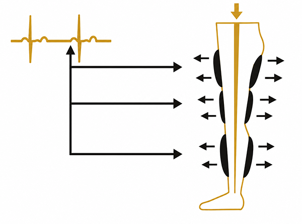 EECP therapy — cuffs deflate before systole to reduce heart workload